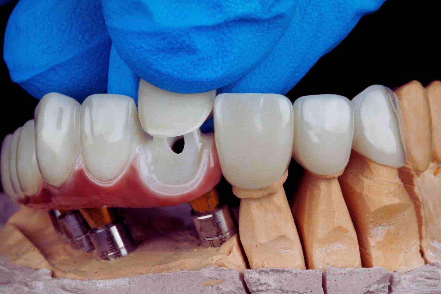 Tooth Decay Under Crown Black Color - Joyce The Dentist