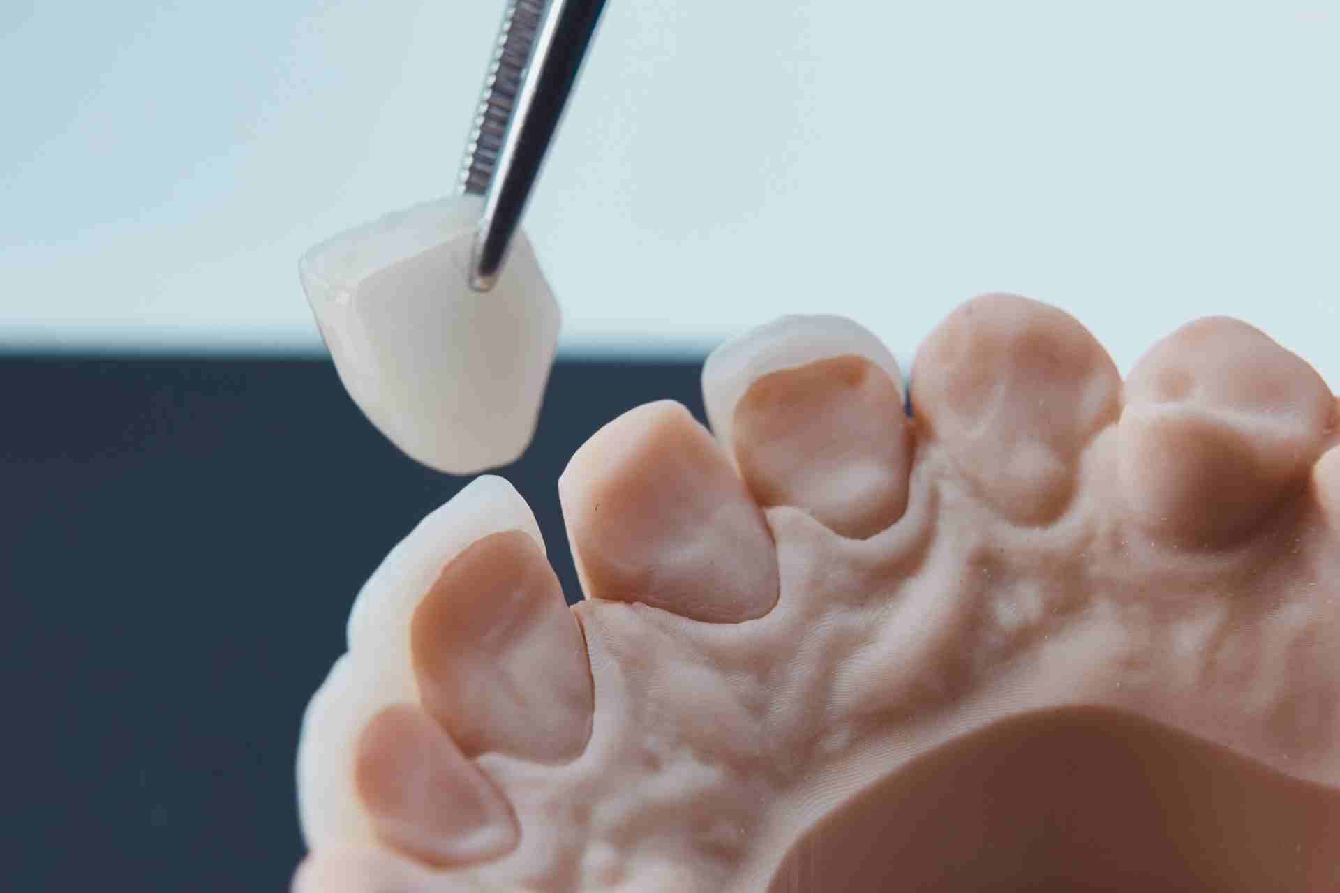 The Downsides of Veneers Why You Should Think Twice