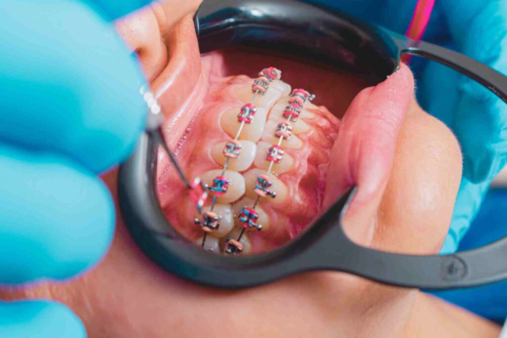 Dental Braces