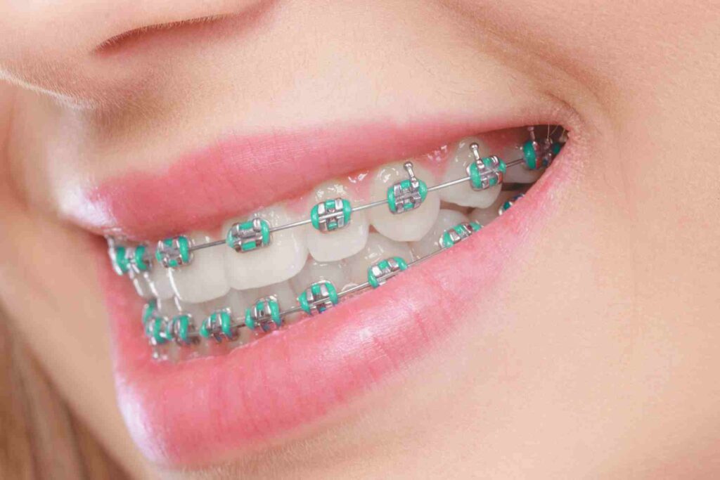 Closeup of woman teeth with braces