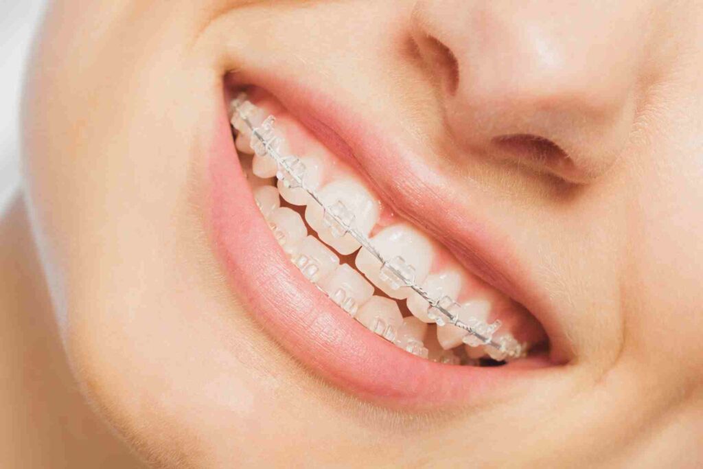 Smile of Young Woman with Dental Braces