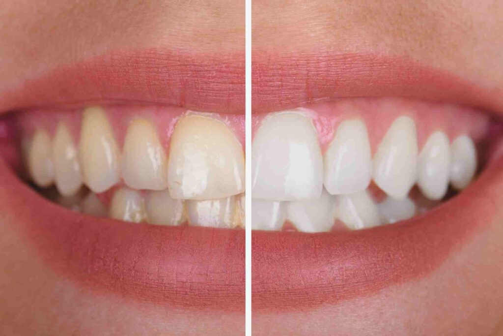 Woman's Teeth Before And After Whitening