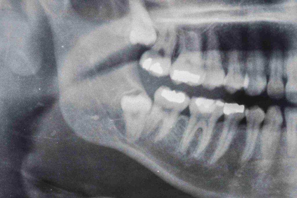 Wisdom tooth x-rays.
