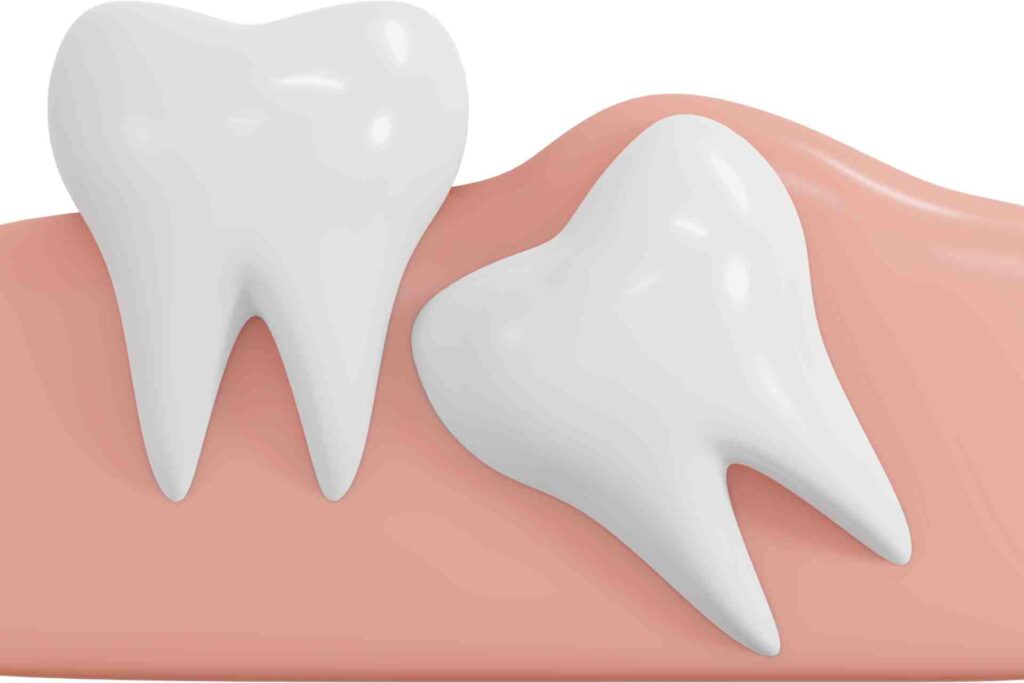 3D icon wisdom teeth angular type