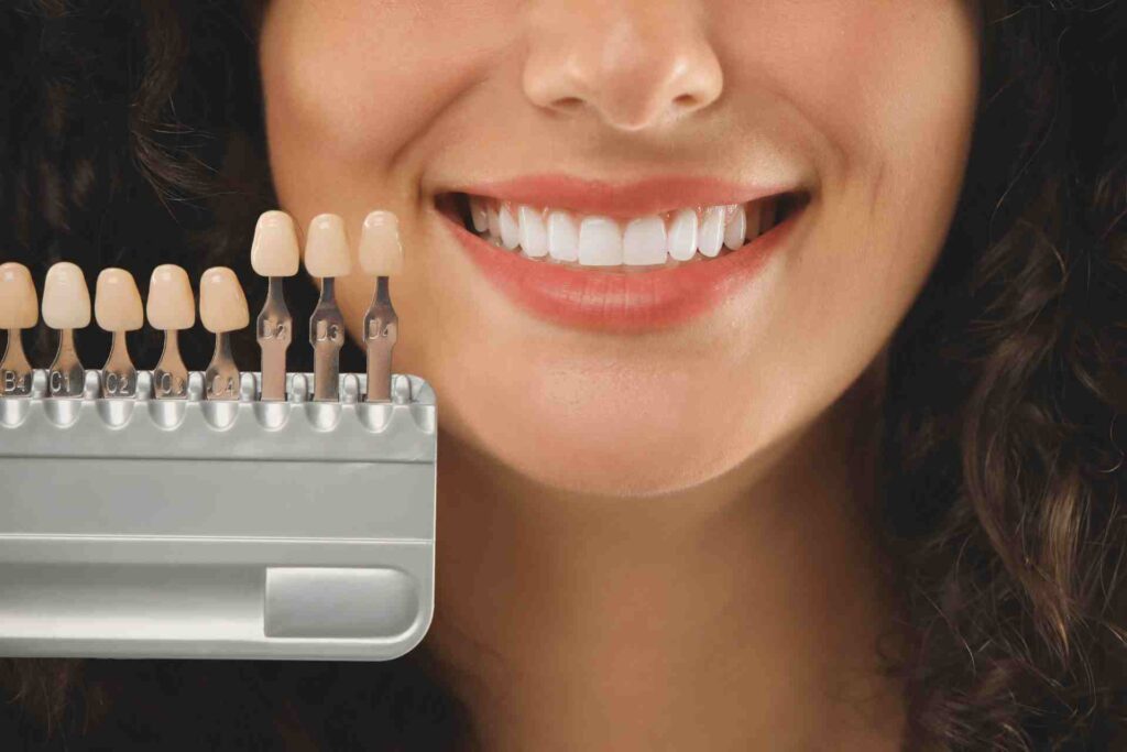 Woman showing dental veneers.