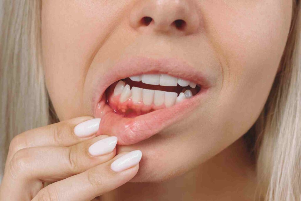 Woman showing red bleeding gums.