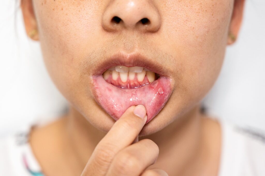 Woman have Aphthous ulcer or Canker sore on mouth at lip
