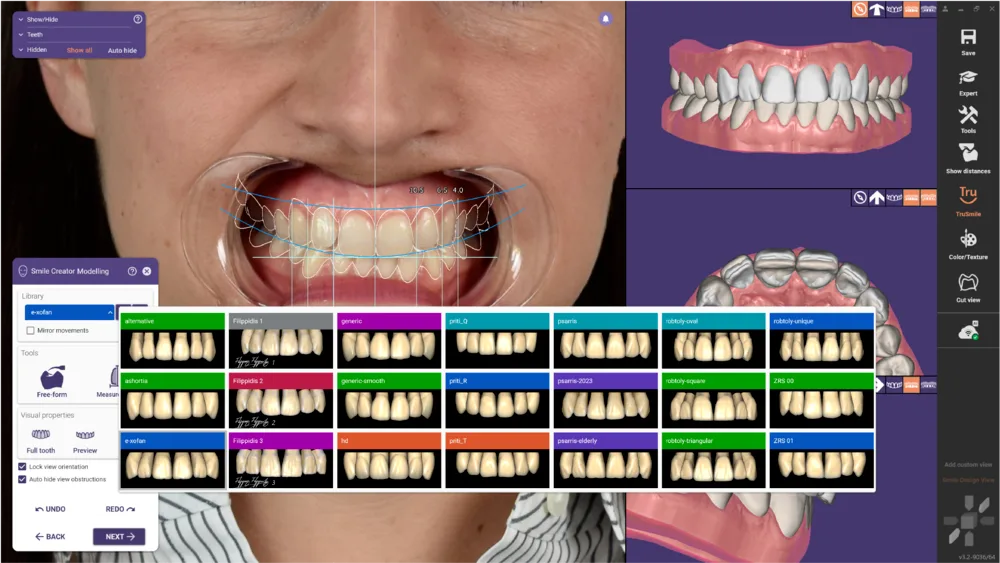 exocad Smile Creator